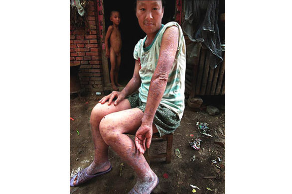 儿子在给艾滋病晚期的病人喂食(图片来自高耀洁博客)艾滋病病毒(hiv)