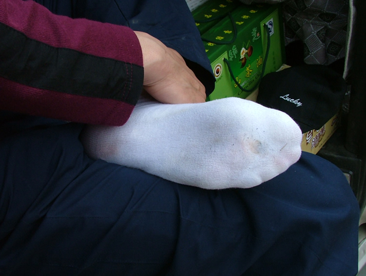 艾师傅的脚，水泡被磨破，袜子湿了一片